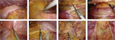 Laparoscopic Proximally Extended Colorectal Resection With Two-Stage Turnbull-Cutait Pull-Through Coloanal Anastomosis for Late Complications of Chronic Radiation Proctopathy